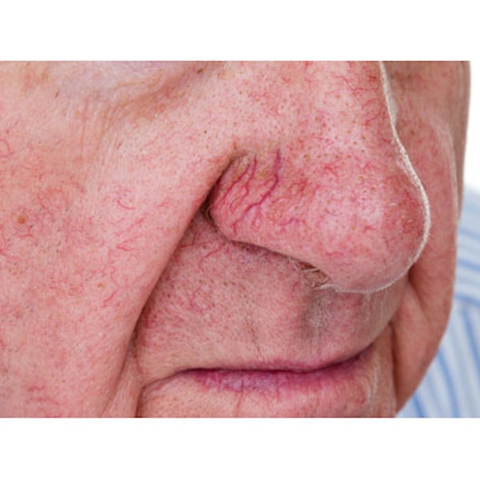 Man with Spider Veins