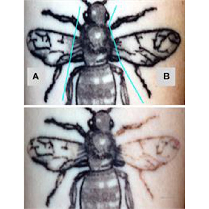 Before and after treatment with laser and laser+RAP