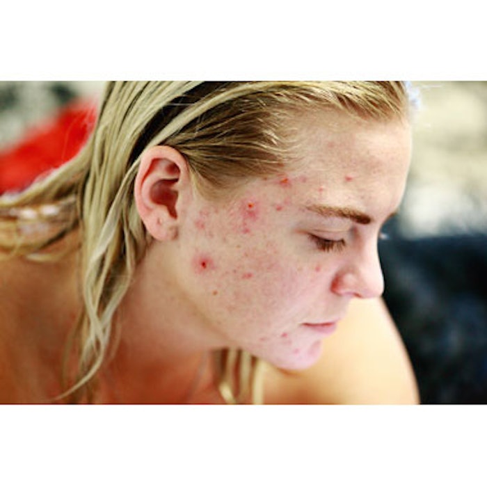Young person with acne