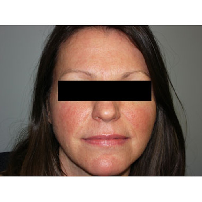 Rosacea patient