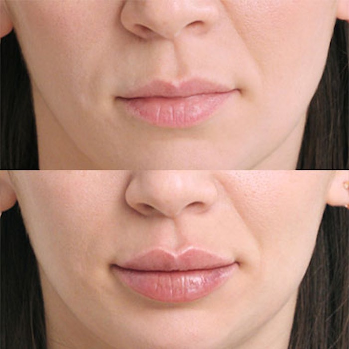 FDA Approves Restylane Kysse