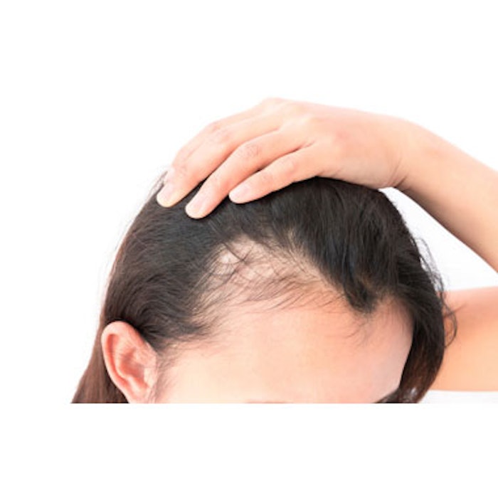 Spironolactone for Female Hair Loss