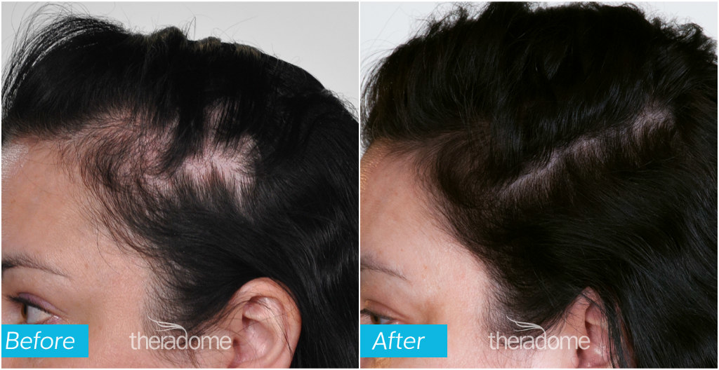Hair loss Stock Photos, Royalty Free Hair loss Images | Depositphotos
