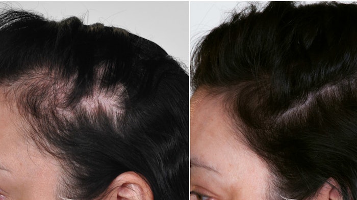 Hair growth after stress