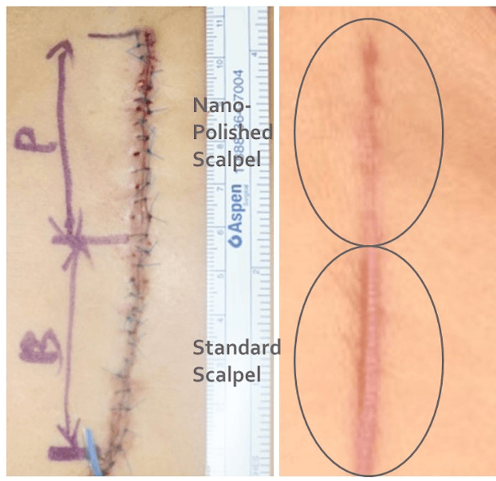 Abdomioplasty