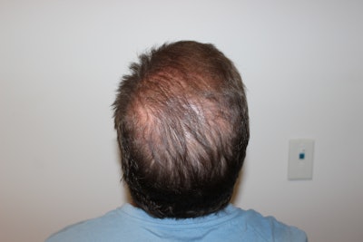 Hf 1801 2 Pt 008 (k L) Visit 1 (pose 6)