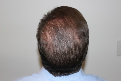 Hf 1801 2 Pt 008 (k L) Visit 4 (pose 6)