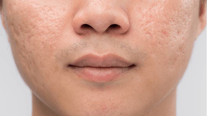 Timolol maleate past laser acne scar treatment