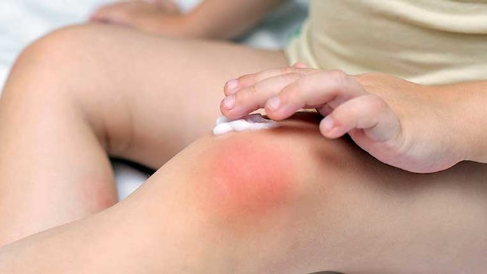 Eczema