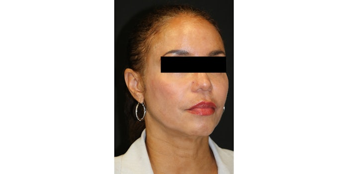 After, Acne