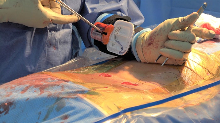 The surgeon uses the Sharp Fluidics Operative Armour system to self-dispense a needle from the suture pack and then self-secures the needle into the Needle Trap after the stitch is thrown.