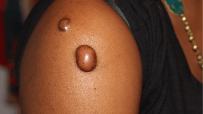 File:Stretched nipple piercing.jpg - Wikimedia Commons