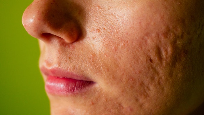 Comapring RF modalities for acne scars