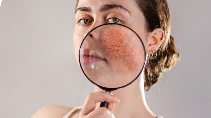 Woman with rosacea
