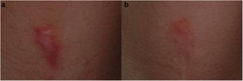 Keloid in a 34‐year‐old female before (a) and after (b) 17 treatment sessions with a long‐pulsed 1064 nm Nd:YAG laser. The patient reported pain symptoms decreased from 7 to 0.