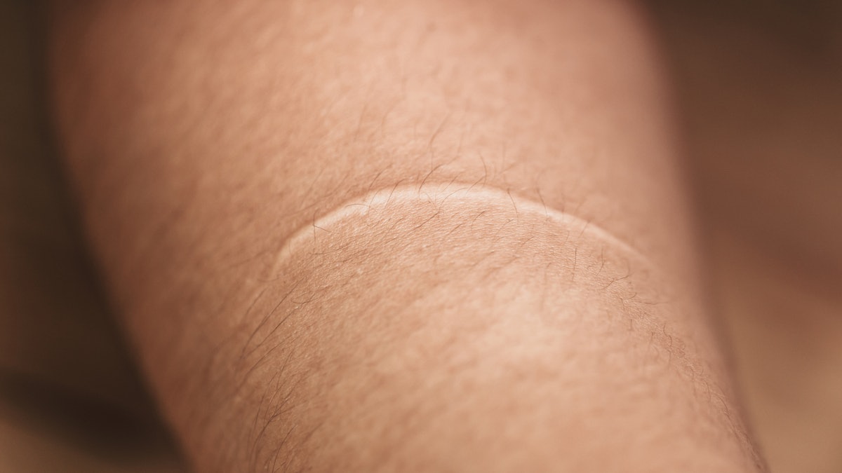 Medical Microneedling Scar Treatment Delivers High Patient Satisfaction