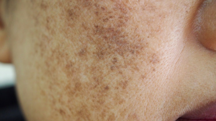 Woman with melasma