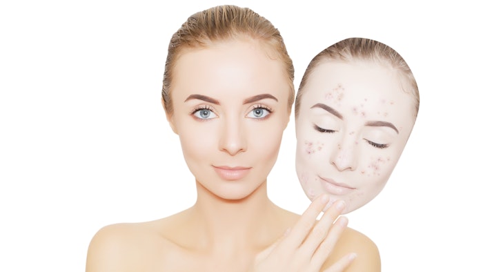 Hoth Therapeutics' HT-003 shown to be effective, in vitro, in the treatment of acne.