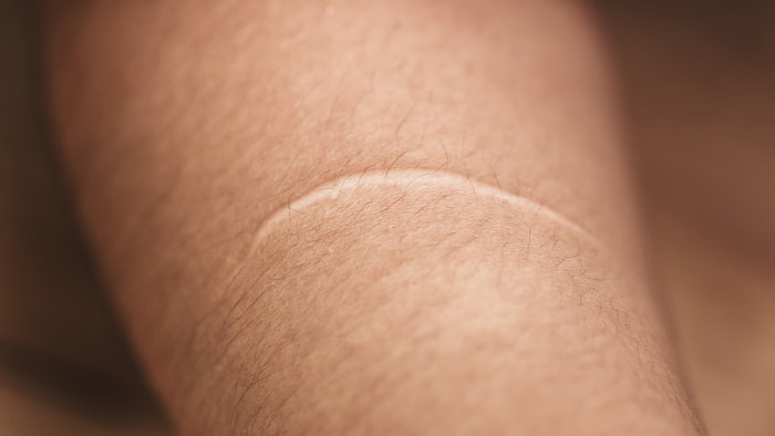 Women with scar
