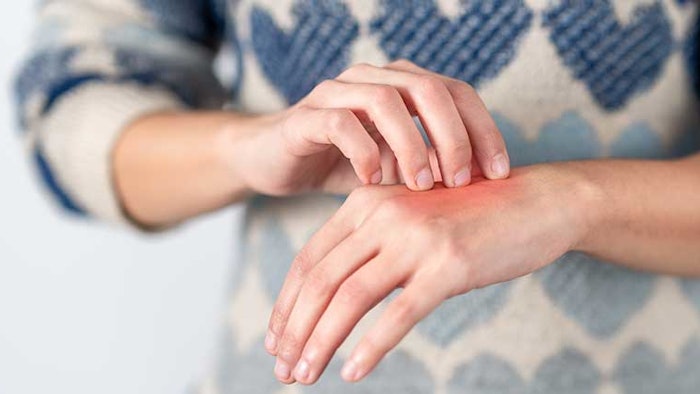 Woman scratching eczema on hand