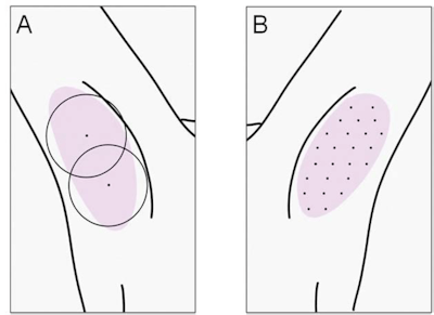Radial (A) and multiple puncture injection (B) techniques used in the study.