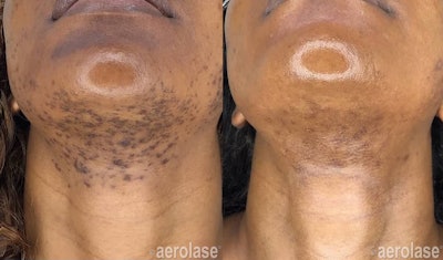 Hair removal, PFB reduction, post-inflammatory hyperpigmentation reduction, and skin rejuvenation after 3 Neo Elite treatments. Photos courtesy of Sholema Aesthetic and Laser Clinic, Lagos, Nigeria