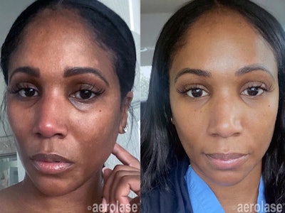 Melasma clearance and skin tone, texture, and quality improvement after 4 Neo Elite treatments. Photos courtesy of LaMone Aesthetics Spa, Bryn Mawr, PA