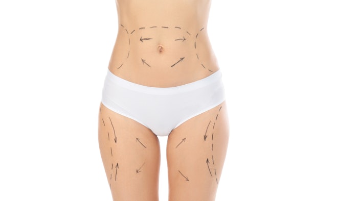 Woman with marks on body for cosmetic surgery
