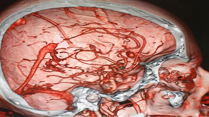 Angiography of human head