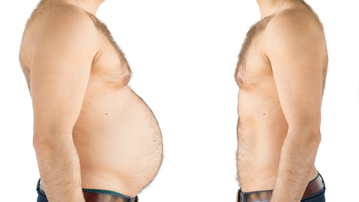 High-intensity focused electromagnetic procedure reduced both subcutaneous and visceral abdominal fat.