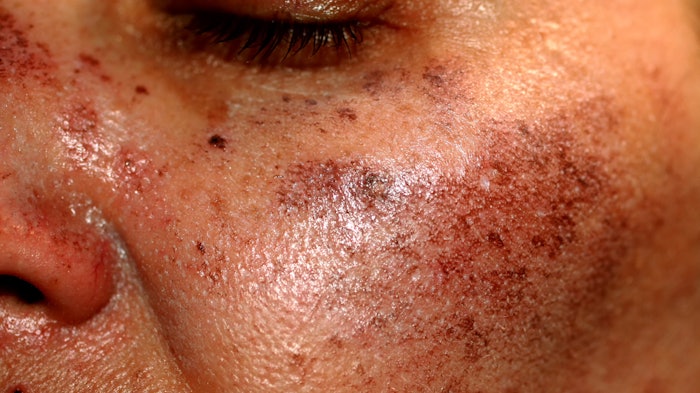 Women with pigmented areas on face
