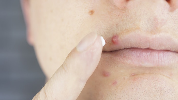 Woman putting cream on pimple