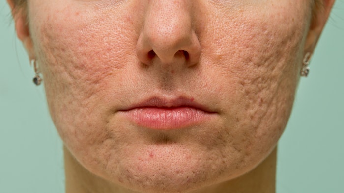 Acne scars