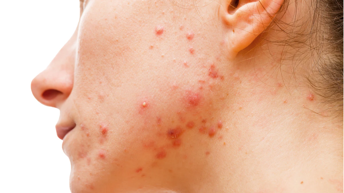 Autophagy‐activating Peptide Reduces Acne and Improves Barrier Function