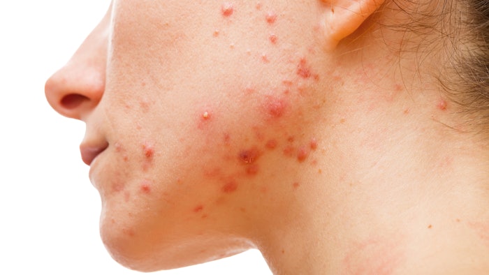 Telemedicine lends itself to the diagnosis of dermatologic conditions, such as acne.