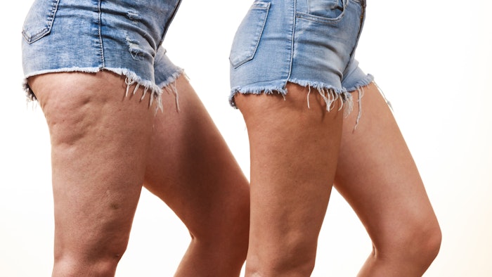 Cellulite on legs