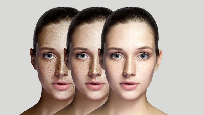 Woman getting treatment for photodamage