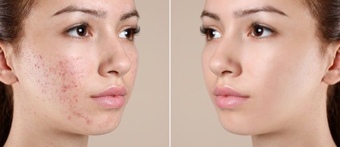 Investigational drug IDP-126 is a combination retinoid, antibacterial and antibiotic topical for treatment of acne vulgaris.