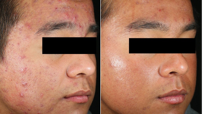 Before and one year post two treatments with the Accure laser.