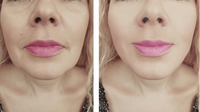 The study found that, in addition to revolumizing, fillers also 'lifted' specific regions of the face.