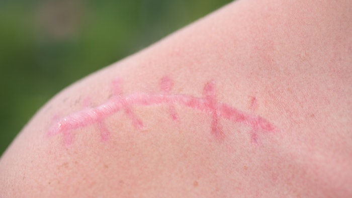 Scar on shoulder