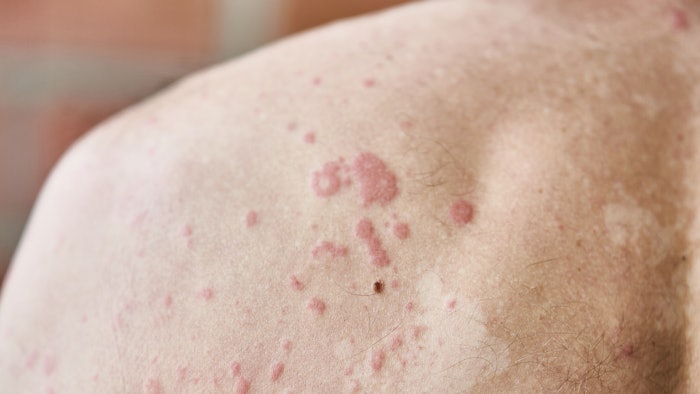 Man with inflammatory skin