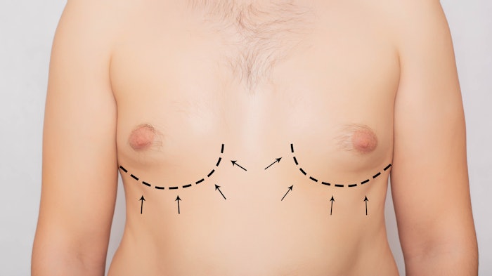 Man with fatty pectoral