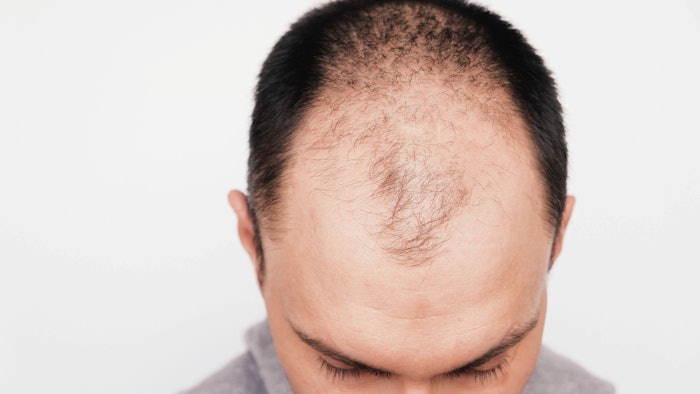Hair Loss Biomarker Can Determine COVID-19 Disease Severity in Men |  MedEsthetics