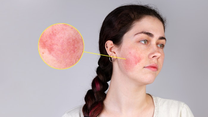 Phase 2 study of CAGE Bio's novel ionic-liquid based product, CGB-400 Topical Gel, for rosacea has commenced.