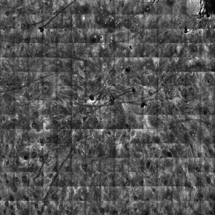 Reflectance Confocal Microscopy Image (Viva block 8x8mm) at the dermal-epidermal level shows presence of widespread atypical melanocytes with follicular infiltration, non edged papillae and junctional thickened; these features will correspond to Melanoma Lentigo Maligna Type.