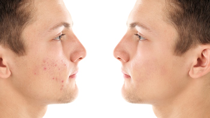 Inflammatory acne treatment with low dose isotretinoin and pulsed dye laser more effective than isotretinoin alone.