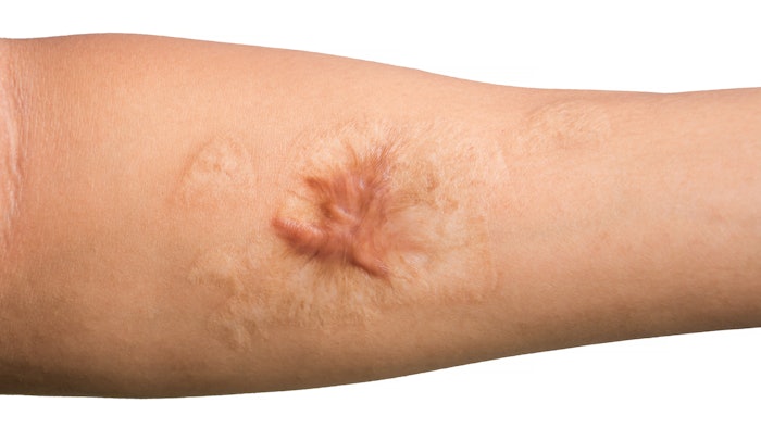 MIMEDX Purion processed dehydrated human amnion/chorion membrane (dHACM) combats complications stemming from excessive fibrosis.