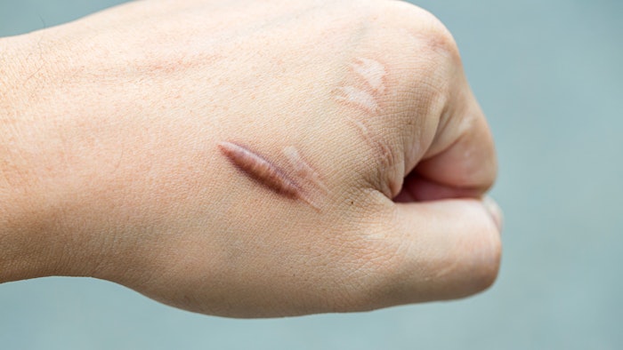 Both botulinum toxin and PRP injections offered more signifcatnt improvement in keloids than triamcinolone acetonide.