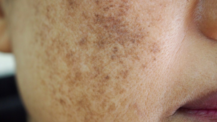 The Difference Between Melasma and Other Skin Spots